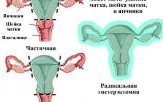 Последствия рака шейки матки: особенности и клиническая картина
