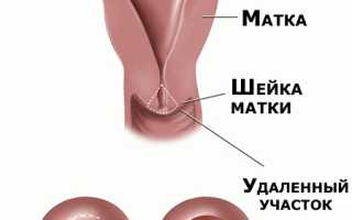 Конизация шейки матки при дисплазии: обзор методик и рекомендаций