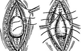 Что такое вентрофиксация матки?