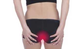 Эффективные методы лечения и профилактики анального кандидоза