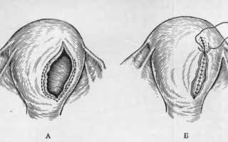 Перфорация матки: основные причины, симптомы и способы лечения