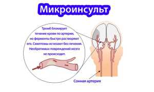 Признаки инсульта: первая помощь, симптомы предвестников