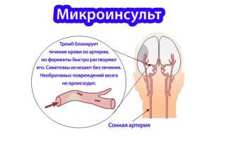 Признаки инсульта: первая помощь, симптомы предвестников
