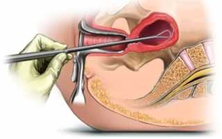 Все о месячных после удаления полипа