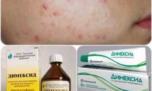 Как правильно применять Димексид?