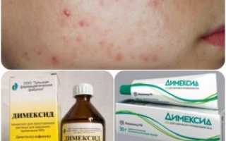 Как правильно применять Димексид?
