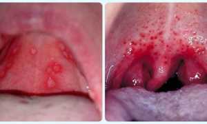 Герпесная ангина — причины и симптомы, диагностика и методы лечения