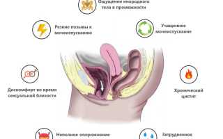 Чувство неполного опорожнения мочевого пузыря у женщин — Почки