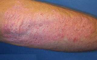 Причины, стадии развития псориаза на ногах и его лечение