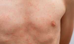 8 возможных причин кожной сыпи, о которых нужно знать каждому