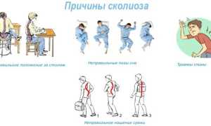 Сколиоз – лечение у детей, подростков и взрослых