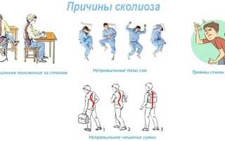Сколиоз – лечение у детей, подростков и взрослых