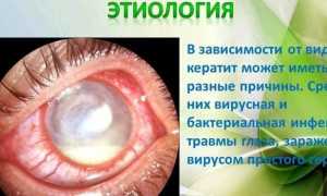 Кератит глаза у человека — симптомы и лечение