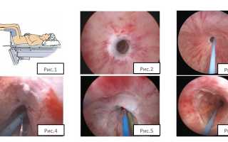 Операция воут в урологии