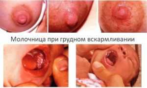 Лечение молочницы при грудном вскармливании