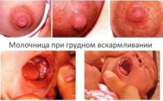 Лечение молочницы при грудном вскармливании