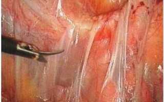 Спайки после операции по удалению матки: причины, симптомы и лечение