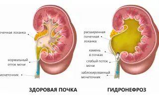 Основные причины расширения лоханки почки