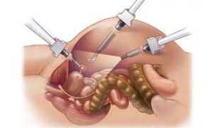Гистерэктомия — показания и техника проведения операции