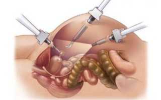 Гистерэктомия — показания и техника проведения операции