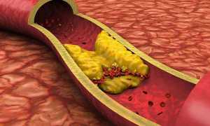 Гиперхолестеринемия – что это такое, симптомы,причины и виды заболевания, диагностика и методы лечения