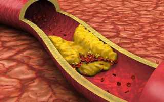 Гиперхолестеринемия – что это такое, симптомы,причины и виды заболевания, диагностика и методы лечения