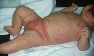 Особенности протекания псориаза у детей