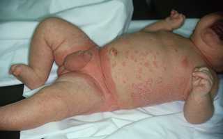 Особенности протекания псориаза у детей