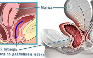 Почему развивается опущение мочевого пузыря после удаления матки?