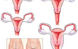 Причины и лечение болей суставов после удаления матки и придатков