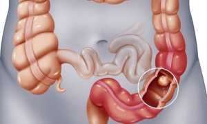 Ирригоскопия кишечника — назначение, подготовка и методика проведения