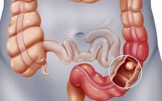 Ирригоскопия кишечника — назначение, подготовка и методика проведения