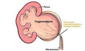 Причины гидронефроза почек — симптомы, диагностика и методы лечения