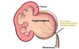 Причины гидронефроза почек — симптомы, диагностика и методы лечения