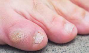 5 причин появления грибка на мизинце ноги