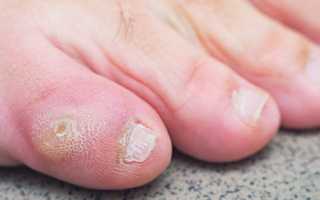 5 причин появления грибка на мизинце ноги