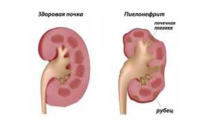 Пиелонефрит при беременности