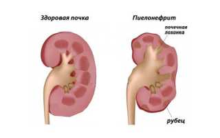 Пиелонефрит при беременности