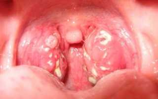 Ангина у детей: симптомы, лечение, фото