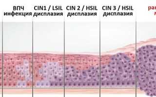 Последствия дисплазии шейки матки и как их избежать?