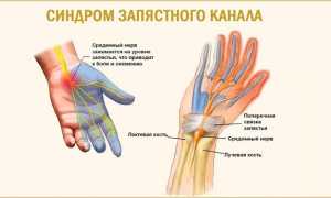 Причины и лечение боли в запястьях правой или левой руки