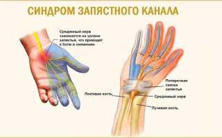 Причины и лечение боли в запястьях правой или левой руки