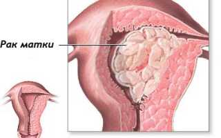 Эффективность гормонотерапии при лечении рака матки