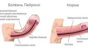 Лечение болезни Пейрони без операции консервативными методами