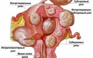 Как изменяются месячные при миоме матки?