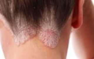 Профилактики и лечение перхоти шампунем Кето Плюс