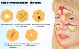 Гайморит при беременности — симптомы, лечение и последствия