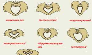 Роды без разрывов, возможно или нет?