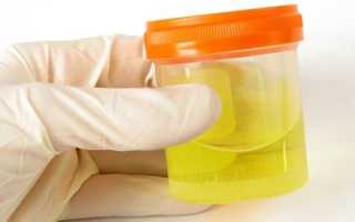 Лейкоциты в моче — норма у детей и взрослых, причины отклонений