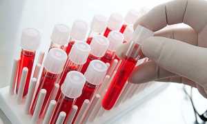 Инфекционный мононуклеоз — пути заражения, симптомы и лечение